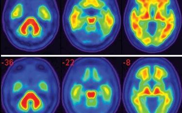 Przedkliniczne fazy choroby Alzheimera (RA Sperling et al.