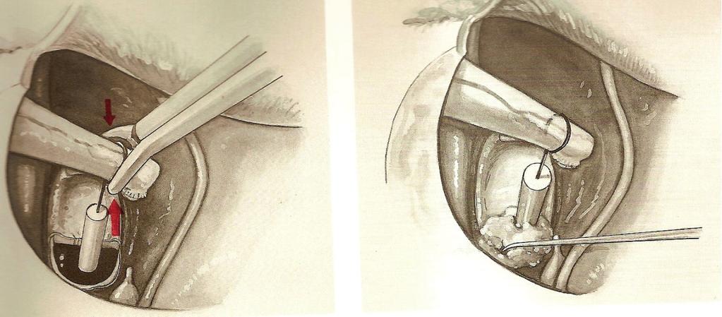 Jerzy Tomik, Beata Solowska Ryc. 1. Stapedectomia (wg. Jahrsdoerfera i Helmsa). Usunięcie płytki lub wykonanie w niej otworu przeprowadza się przy użyciu odpowiednich narzędzi mikrochirurgicznych.