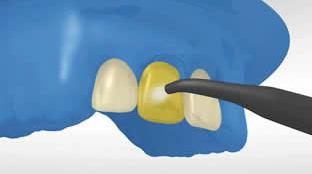 5 Wstępne opracowanie powierzchni zęba i aplikacja materiału łączącego Opcjonalny: Najpierw wytrawić opracowane szkliwo stosując Total Etch (37% kwas ortofosforowy w postaci żelu), a potem zębinę