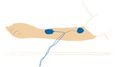 Naprzemienna Elektroda (-) Nad mięśniami zginającymi odśrodkowo na górnej 1/3 części przedramienia Elektroda (+) Nad mięśniami zginaczy