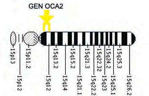 W 1995 roku grupa badaczy z Uniwersytetu w Kopenhadze wykryła pojedynczą mutację w obrębie genu OCA2, znajdującego się na chromosomie 15 (Ryc.