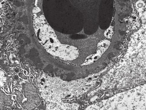 Subepithelial deposits partialy enclosed by the glomerular basic membrane material. Electron microscopy. Original magnification 3000x.