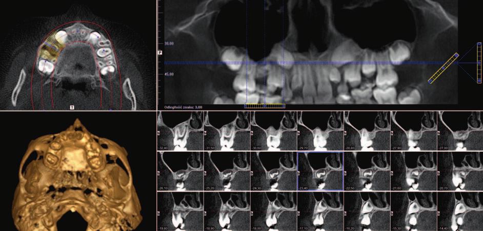 CLINICAL ORTHODONTICS 1/2018 Pacjent J.L., lat 9 Pacjent zgłosił się 16.11.2015 r.