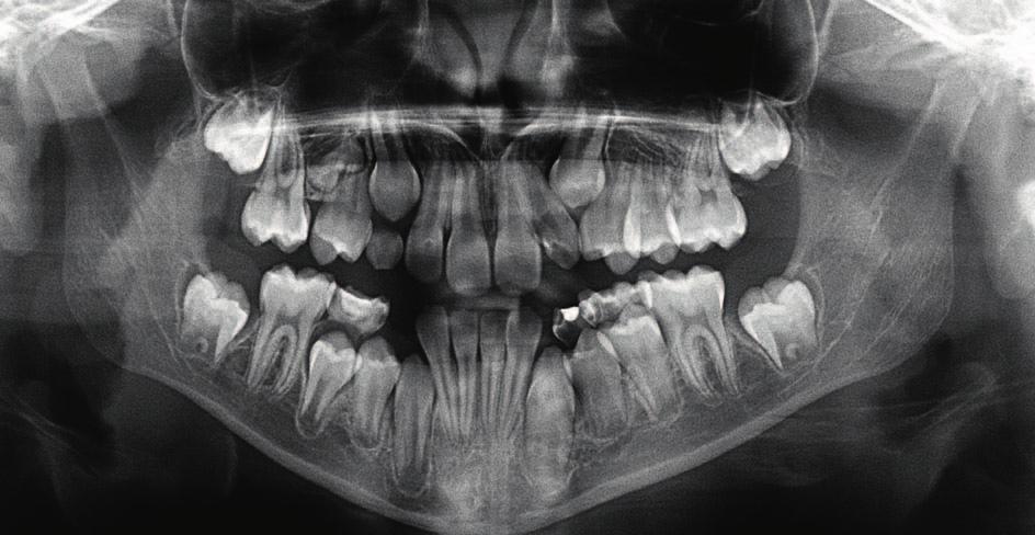 po analizie obrazu CBCT stwierdzono obecność szczątkowego zawiązka zęba 15 brak rozwoju korzenia tego zęba. W lutym 2017 r.