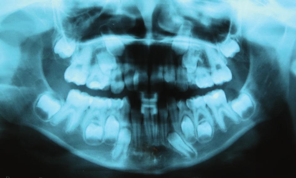 CLINICAL ORTHODONTICS 1/2018 4a 4b 4c Ryc. 4a. Pacjentka M.M. (2011 r.), widoczny brak zawiązka zęba 15 oraz opóźniony rozwój zęba 25 Ryc. 4b. Pacjentka M.M. (2015 r.