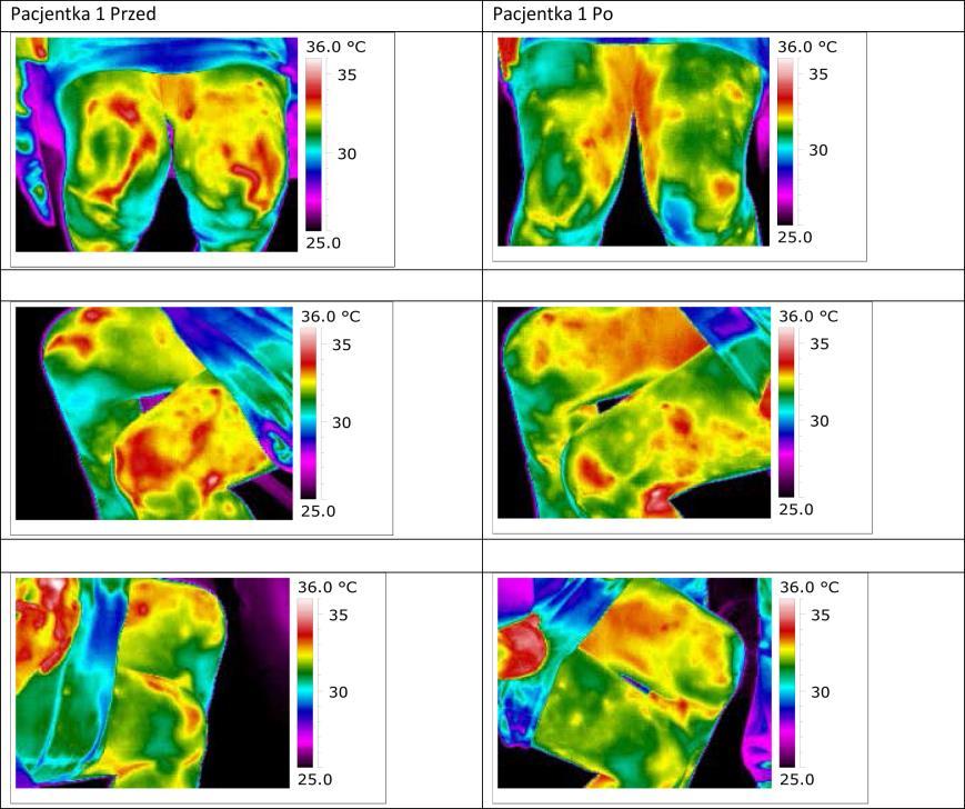 Patient 1 before Patient 2 after Figure 1. Image left knee made infrared camera before and after surgery. The mechanism of action of electromagnetic DBS has not yet been fully elucidated.