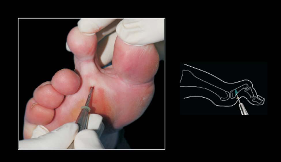 Mini-incision surgical treatment of mallet toe deformity than the longer flexor, and which, besides that, is already loose as a result of tenotomy performed on it.