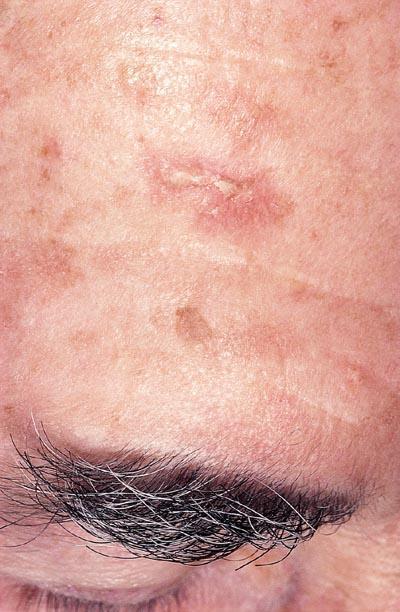 KERATOSIS