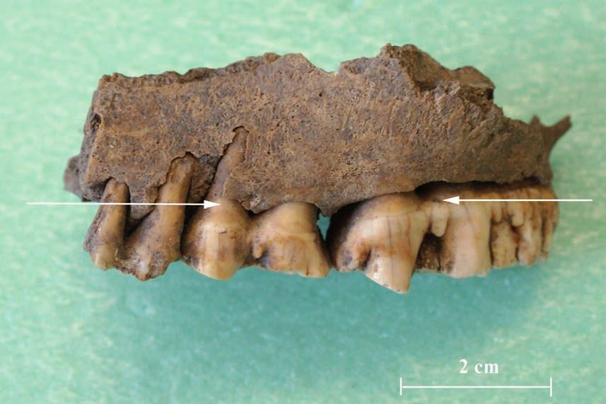 Periodontitis on a Medieval pig s jaw bone związanej ze szkieletem osiowym to 19% (szponder, rostbef, rozbratel, antrykot).
