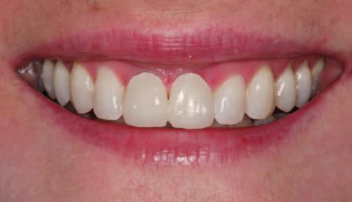 Oczywiście tym problemem możemy zajmować się niezależnie od leczenia estetycznego zębów górnych, mając na uwadze fakt, iż to położenie zębów górnych doprowadziło w pewnym sensie do