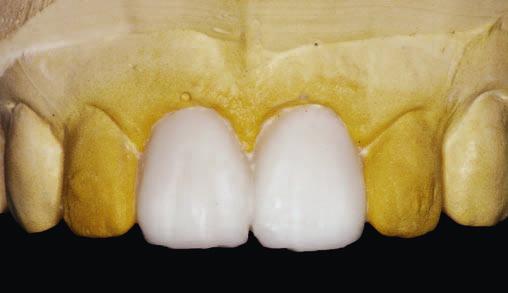 rogów miazgi, pozostawionej podczas poprzedniego leczenia. Był to główny powód ciemnienia części koronowej zębów.
