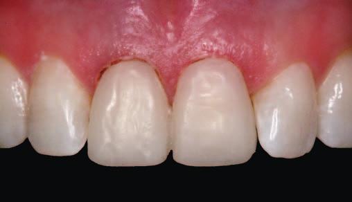 Po dyskusji z technikiem dentystycznym zleciliśmy przygotowanie nowego kształtu zębów na modelu (wax-up) (fot. 7).