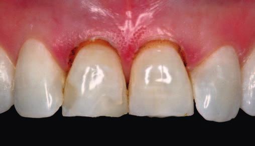 W takiej sytuacji często używamy koloru mocno kontrastowego, w tym wypadku A 3,5, aby lepiej zobrazować faktyczny zakres zmiany kształtu i pozycji zębów (fot. 8).