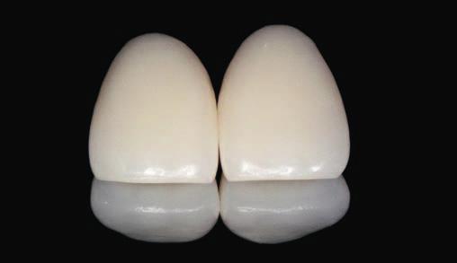 10/2010 STOMATOLOGIA ESTETYCZNA 38 odbudowie zębów po leczeniu kanałowym (fot. 12). W związku z tym, iż nie byliśmy zadowoleni z uzyskanego kształtu, zleciliśmy wykonanie kolejnego modelu wax-up (fot.