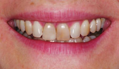 Natomiast widoczne niewielkie recesje dziąseł przy zębach w odcinkach bocznych oraz starcie dolnych siekaczy (fot. 6, str.