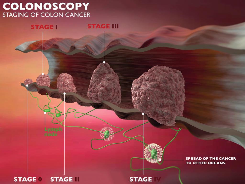 Stadium I rak jest ograniczony do ściany jelita. Stadium II rak przeszedł przez ścianę jelita, ale nie rozprzestrzenił się do węzłów chłonnych.