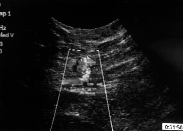 Folia Cardiol. 2003, tom 10, nr 2 Rycina 1. Obraz w prezentacji dwuwymiarowej tętniaka rzekomego tętnicy udowej Figure 1. Duplex ultrasound of a femoral pseudoaneurysm wem przedłużonego ucisku [4].