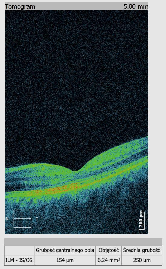 Treatment progression without treatment after treatment