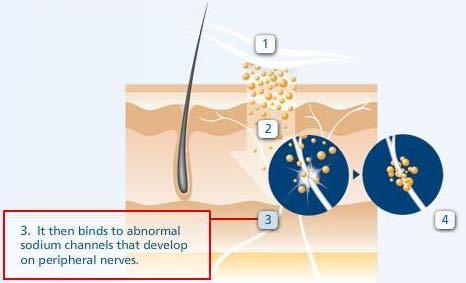 Mechanizm działania 5% lidokainy (w plastrze) Lidokaina uwalniana z plastra, wiąże się z wewnętrzną ścianą patologicznych VGSC powstającymi w