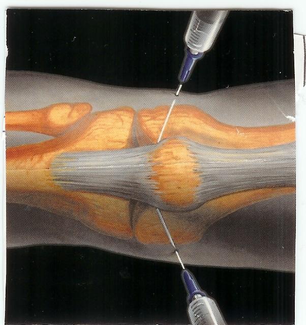 Evaluation of analgesic efficacy of intra-articular opioids (morphine, fentanyl)