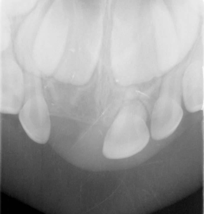 Kontrolne zdjęcie RTG po 2 latach od urazu wykazało wyraźne zaokrąglenie brzegów zarówno fragmentu wierzchołkowego, jak i fragmentu koronowego korzenia zęba 61 (ryc. 4).