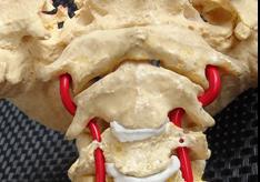 Anatomia chirurgiczna Bardzo istotne rozpoznanie linii środkowej najważniejszy marker kostny - guzek przedni atlasu Pamiętaj!
