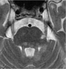 symptomatologia MRI Stwardnienie rozsiane T1 izo,hipointensywne,