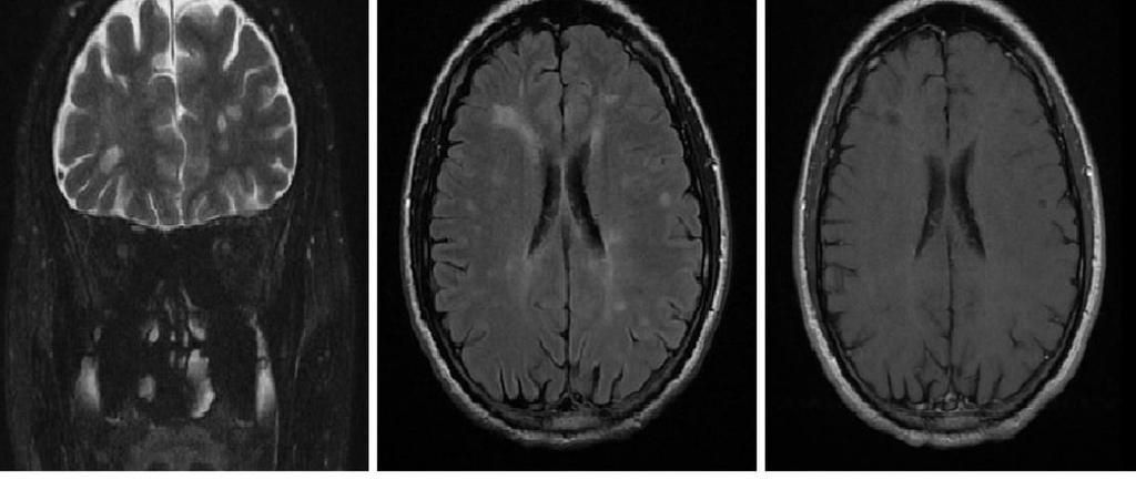 Neurosarkoidoza