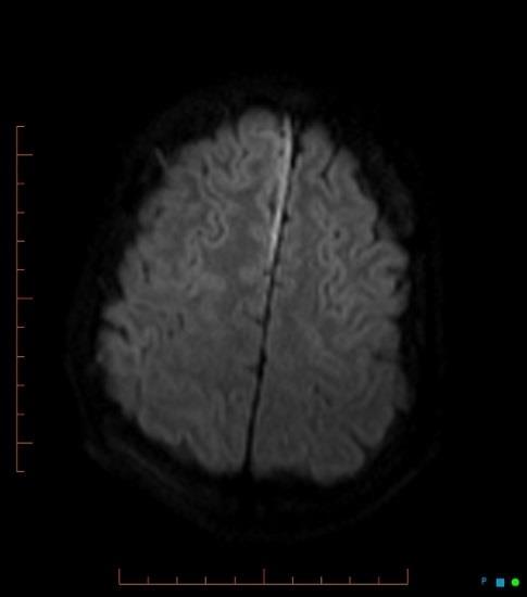 cd Resolution of restricted diffusion in the splenium (arrow). Worsening of right frontal subdural empyaema. Persistent "cerebritis" in right frontal lobe.