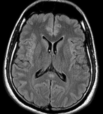 antiepileptic drug usage and sudden cessation demyelination multiple sclerosis (MS) acute disseminated encephalomyelitis (ADEM) posterior reversible encephalopathy syndrome