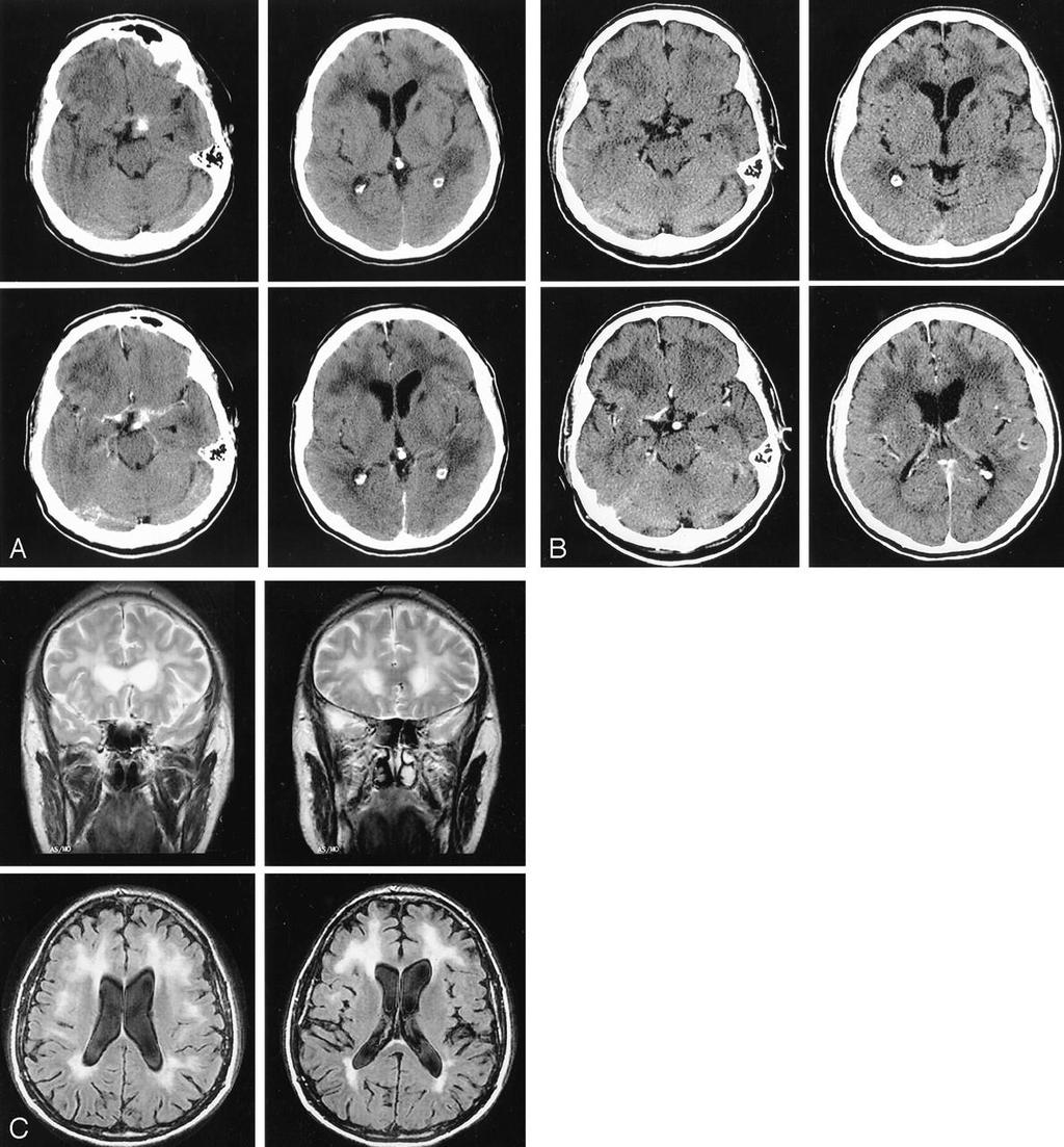 A, Nonenhanced (top) and enhanced (bottom) brain CT scans show left small subthalamic hematoma with perivascular enhancement