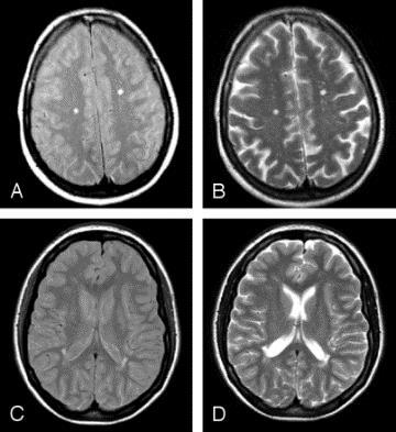 B, CT scans obtained 4 months after treatment show that hemorrhage and perivascular enhancement have disappeared, but lacunar