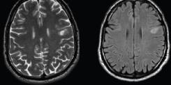 Markery obrazowe w MRI odpowiadające w/w