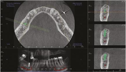 InVivo Dental umożliwia: pracę w obrębie standardowych rzutów 2D (strzałkowym, czołowym, horyzontalnym), tworzenie przekroju indywidualnego (dowolny przekrój