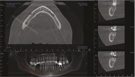 pantomograficznej wraz z przekrojami prostopadłymi do wyrostka zębodołowego szczęki oraz żuchwy, zaawansowaną pracę w formie rekonstrukcji komputerowej