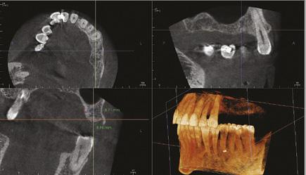 w celu analizy systemu kanałowego zęba zakwalifikowanego do leczenia endodontycznego, planowanie położenia wszczepu implantologicznego z wykorzystaniem