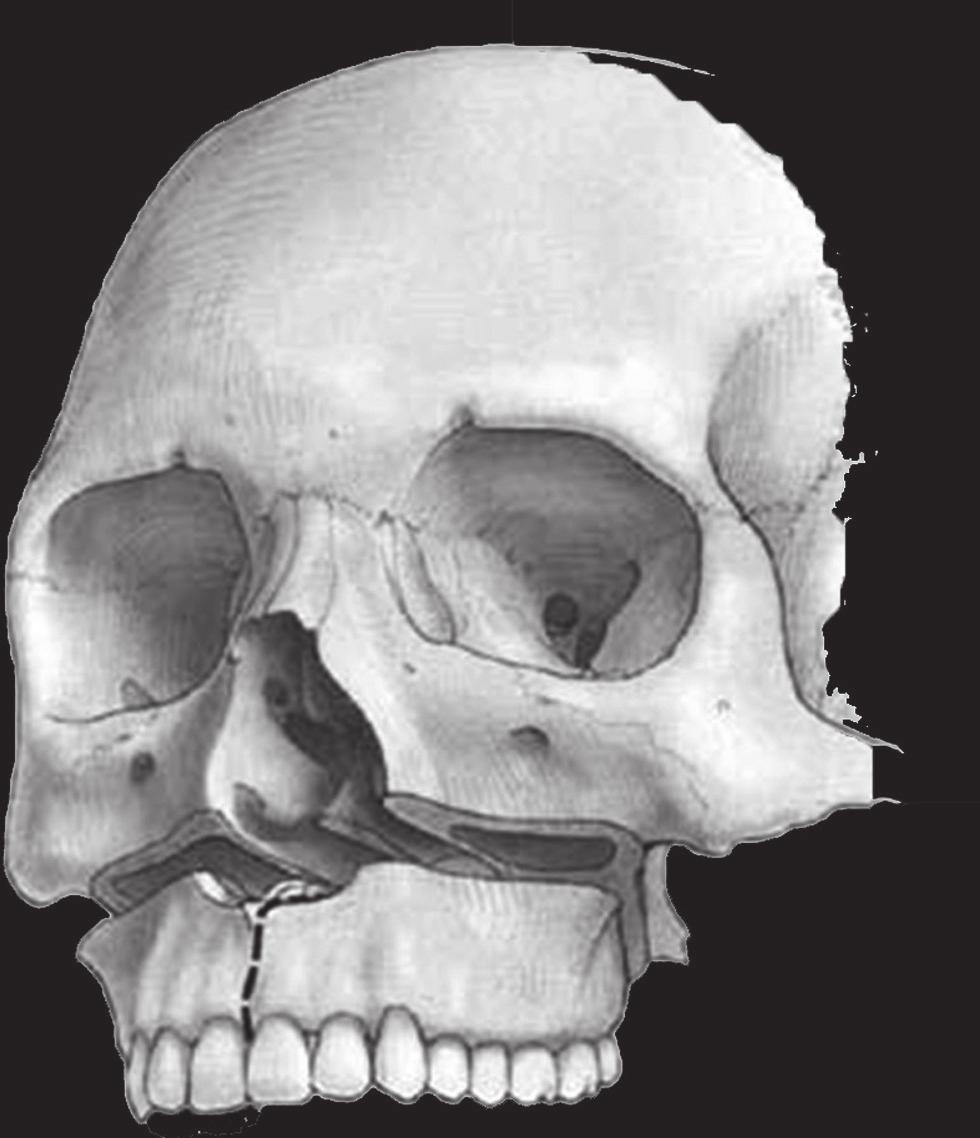 30 G.A. Beltramini i wsp. Rycina 2.11 Osteotomia typu Le Fort I. Osteotomia typu Le Fort I została opracowana w celu oddzielenia części górnej kości szczękowej od jej części zębowej.