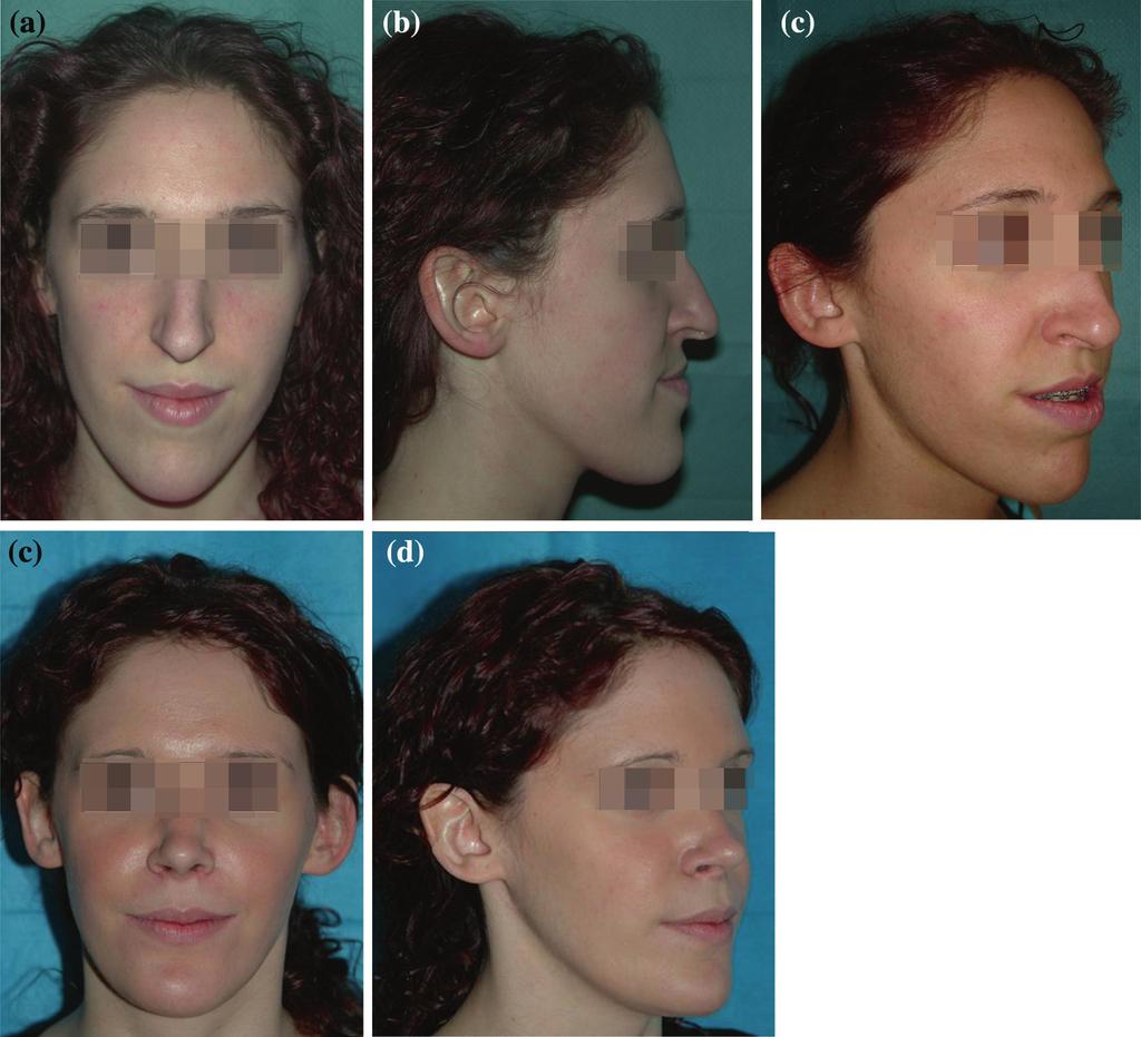 32 G.A. Beltramini i wsp. Rycina 2.13 Przypadek jednoczesnego zabiegu chirurgicznego u pacjentki ze szkieletową wadą zgryzu klasy III i deformacją nosa, asymetrią twarzy, hipoplazją okolicy jarzmowej.