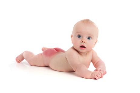 Pieluszkowe zapalenie skóry Pieluszkowe zapalenie skóry Pieluszkowe zapalenie skóry Jednym z najczęstszych schorzeń skóry, z jakimi spotykają się młode mamy, jest pieluszkowe zapalenie skóry (PZS),