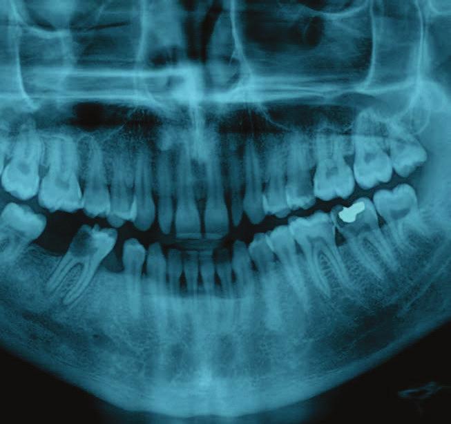 ENDODONCJA CORAZ MNIEJ INWAZYJNA INNOWACYJNE PODEJŚCIE DO OPRACOWYWANIA KANAŁÓW KORZENIOWYCH lek dent. Artur Wierciński, dr n. med.