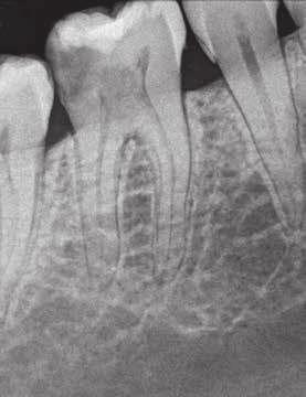 Zdj. 4A B. Ząb 46, rewizja leczenia endodontycznego Zdj. 5A C.