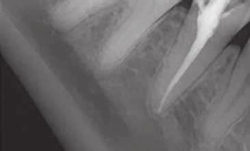 maszynowymi w leczeniu endodontycznym.