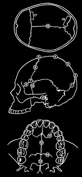 coronal suture 7 Pterion Usually where parietosphenoid suture meets the frontal 8 Sphenofrontal Midpoint of left sphenofrontal suture 9 Inferior Sphenotemporal Intersection between left