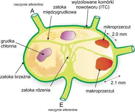 węzłów chłonnych, sprawiając, że węzły chłonne są klinicznie nieme i traktowane jako niezajęte (klinicznie N0).