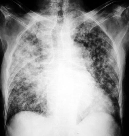 NDRP Badanie mikroskopowe NSCLC 85% SCLC 15% RAK