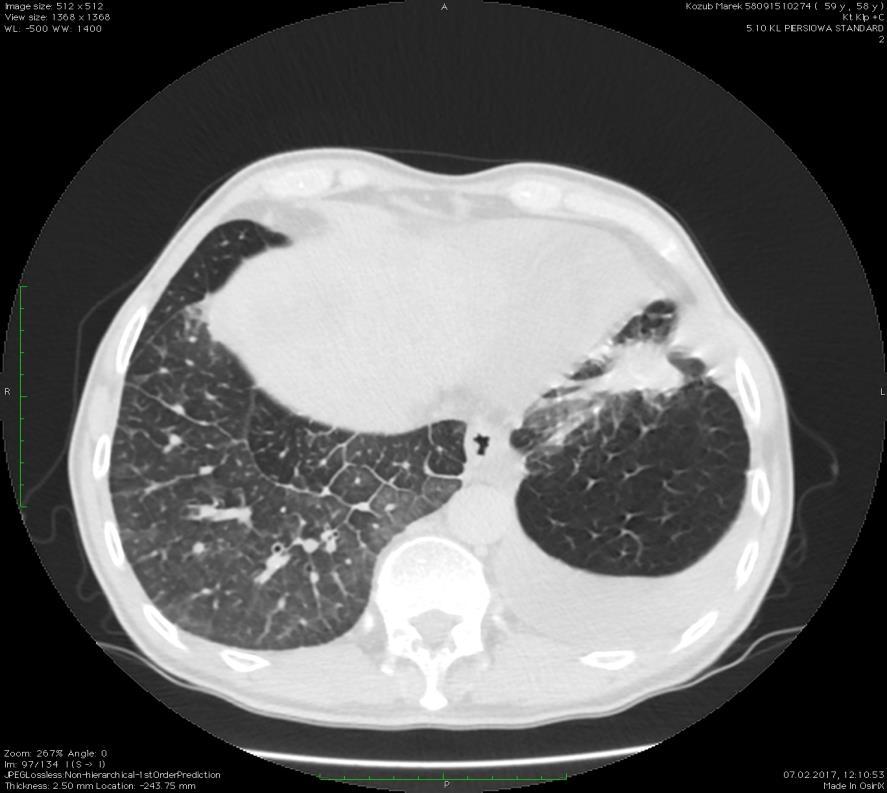 TK klatki piersiowej W segmentach podstawnych płuca prawego