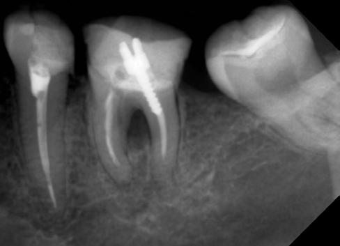 Zdjęcie rtg. zębowe stan po usunięciu metalowego wkładu standardowego i po leczeniu kanałowym zęba 36 dalszy 19/35/06.