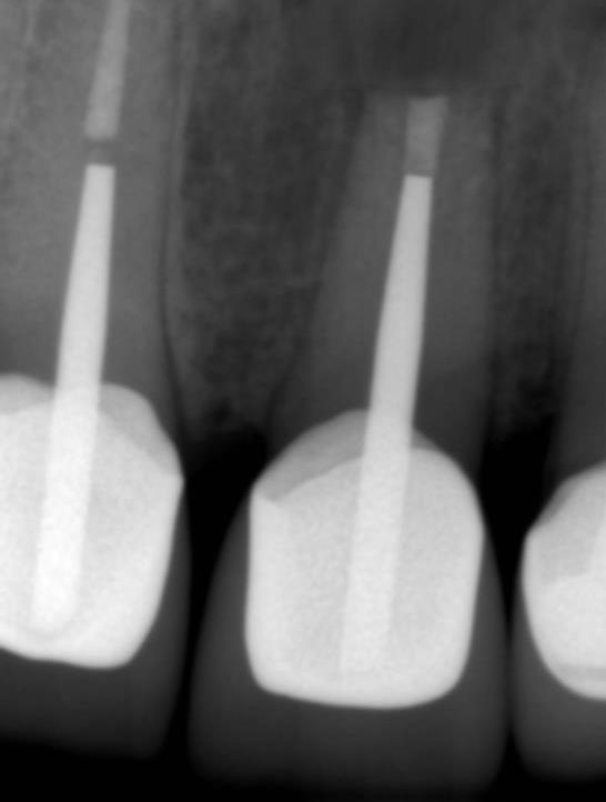 leczeniu kanałowym zęba 21 (wierzchołek zamknięty materiałem