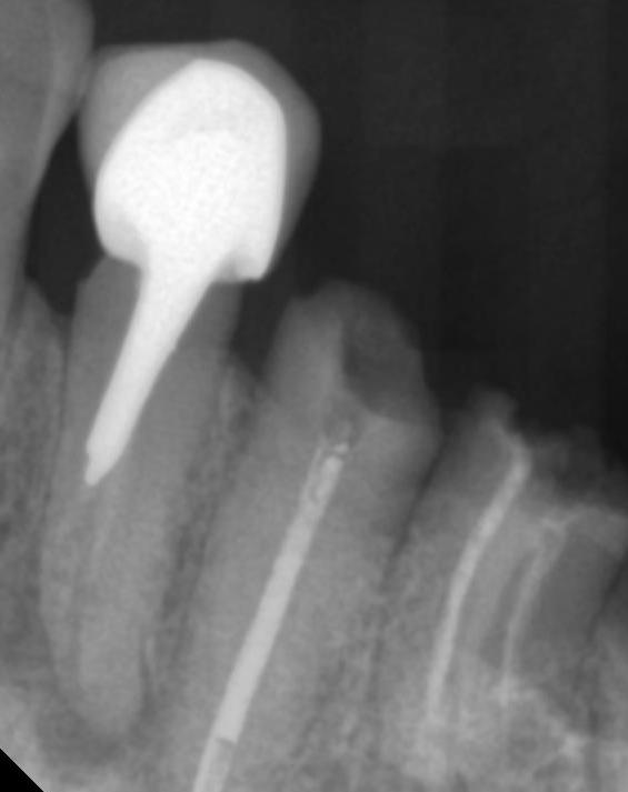 2/2018 4a 4b 4c Ryc. 4a. Zdjęcie rtg. zębowe stan po niekompletnym leczeniu kanałowym zęba 34, ząb odbudowany wkładem indywidualnym i koroną protetyczną Ryc. 4b. Usunięty indywidualny wkład lany Ryc.