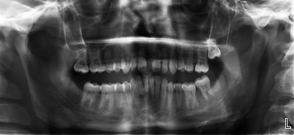 CLINICAL ORTHODONTICS 3/2018 6 7 Ryc. 6. Pacjent z diastemą wynikającą z nieprawidłowego przyczepu wędzidełka wargi górnej Ryc. 7. Przykład pacjenta z diastemą w linii pośrodkowej szczęki spowodowaną rozszczepem wyrostka zębodołowego po stronie lewej oraz hipodoncją zęba 22 Fig.